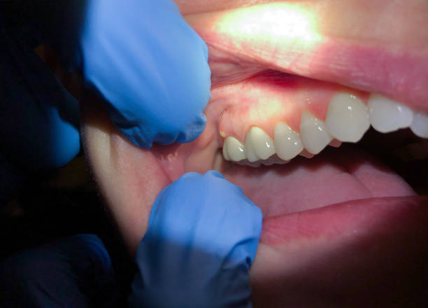 Best Dentist for Tooth Abscess  in Yalaha, FL